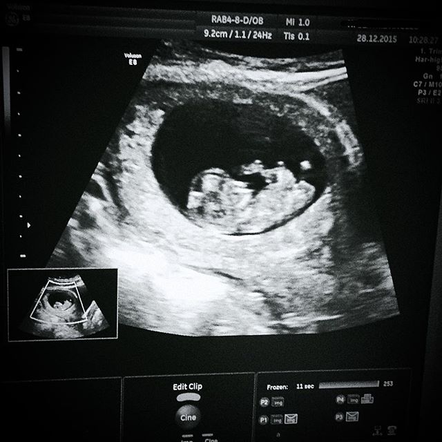 Gravidez 11 semanas Baby bump 11 weeks gestação baby blog ecografia 1º trimestre 13 semanas ultrasound